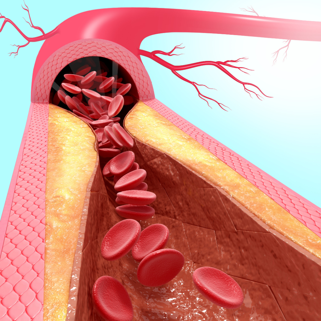 Sintomas de Infarto