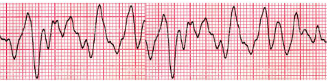 Fibrilação Ventricular