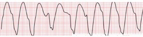 Taquicardia Ventricular