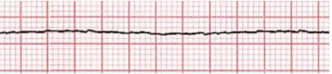 Traçado de eletrocardiograma compatível com assistolia, caracterizado por linha praticamente reta e ausência de complexos QRS identificáveis. Indica ausência de atividade elétrica cardíaca organizada e situação de parada cardiorrespiratória.