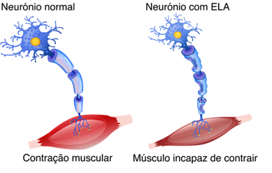 Ilustração comparativa entre neurônio normal e neurônio com ELA (Esclerose Lateral Amiotrófica), mostrando contração muscular preservada versus músculo incapaz de contrair. Representação didática da degeneração neuromuscular.