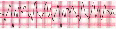 Traçado de eletrocardiograma com padrão compatível com fibrilação ventricular, caracterizado por ondas caóticas e ausência de ritmo organizado. A imagem ilustra uma arritmia grave associada à parada cardiorrespiratória.