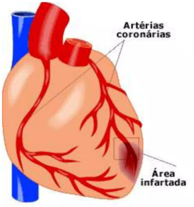 Ilustração anatômica do coração destacando as artérias coronárias e a área infartada, representando um caso de infarto do miocárdio. Imagem educativa sobre obstrução coronariana, isquemia cardíaca e danos ao músculo cardíaco.
