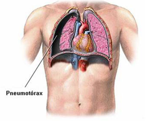 Ilustração anatômica do tórax humano destacando um caso de pneumotórax, com colapso pulmonar visível e representação dos pulmões e coração. Imagem educativa sobre causas, sintomas e complicações do pneumotórax na saúde respiratória.