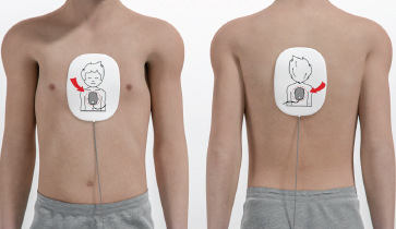 Imagem demonstrando o posicionamento correto dos eletrodos adesivos do desfibrilador (DEA) no tórax anterior e posterior. Orientação visual para uso em parada cardiorrespiratória durante suporte básico de vida.