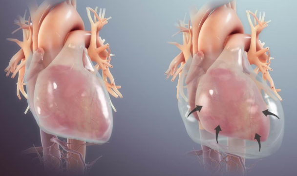 Ilustração 3D comparativa mostrando o coração normal e o tamponamento cardíaco, com acúmulo de líquido no pericárdio comprimindo o músculo cardíaco. Imagem educativa sobre derrame pericárdico e comprometimento da função cardíaca.