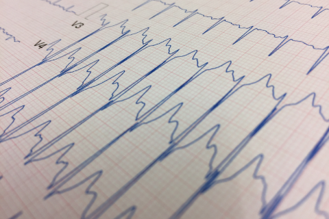 Traçado de eletrocardiograma com ritmo cardíaco acelerado, sugerindo possível taquicardia. A imagem destaca ondas elétricas irregulares no ECG, utilizadas na avaliação de arritmias e outras alterações cardiovasculares.