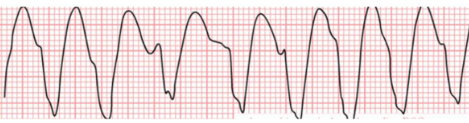 Traçado de eletrocardiograma compatível com taquicardia ventricular, apresentando ritmo rápido, complexo QRS alargado e padrão regular. A imagem representa uma arritmia grave que pode evoluir para parada cardiorrespiratória se não tratada.