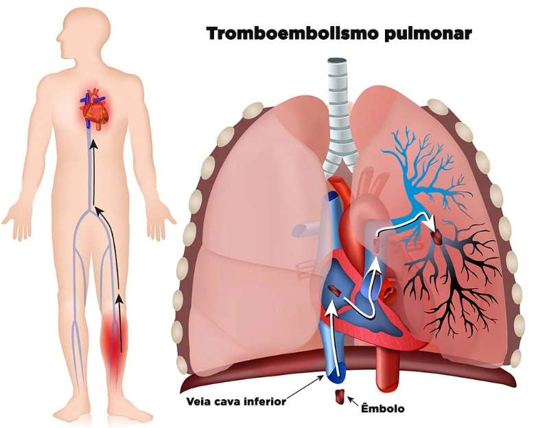 Ilustração explicativa do tromboembolismo pulmonar mostrando a formação do coágulo na perna, seu deslocamento pela veia cava inferior e a obstrução nas artérias pulmonares. Imagem educativa sobre embolia pulmonar e circulação sanguínea.