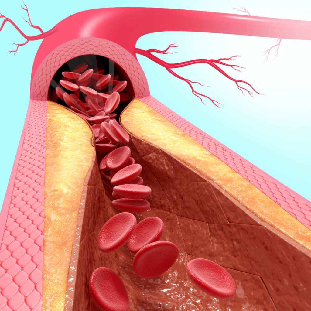 Ilustração médica mostrando uma artéria com acúmulo de placas de gordura nas paredes internas, reduzindo o espaço para passagem do sangue. As hemácias circulam por um canal estreito, representando o processo de aterosclerose.