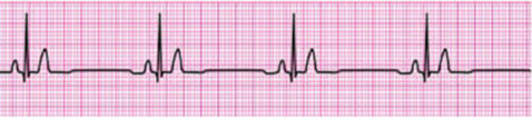 Traçado de eletrocardiograma demonstrando ritmo sinusal normal, com ondas P precedendo cada complexo QRS estreito e intervalos regulares. Padrão compatível com atividade elétrica cardíaca organizada e frequência dentro da normalidade.